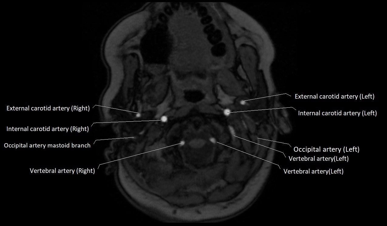 Carotid artery anatomy axial 3T image 8.jpg